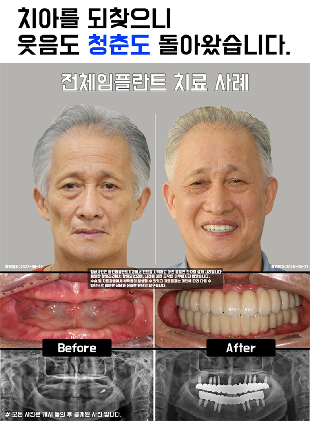 광진정플란트치과 모바일 메인 비주얼 3