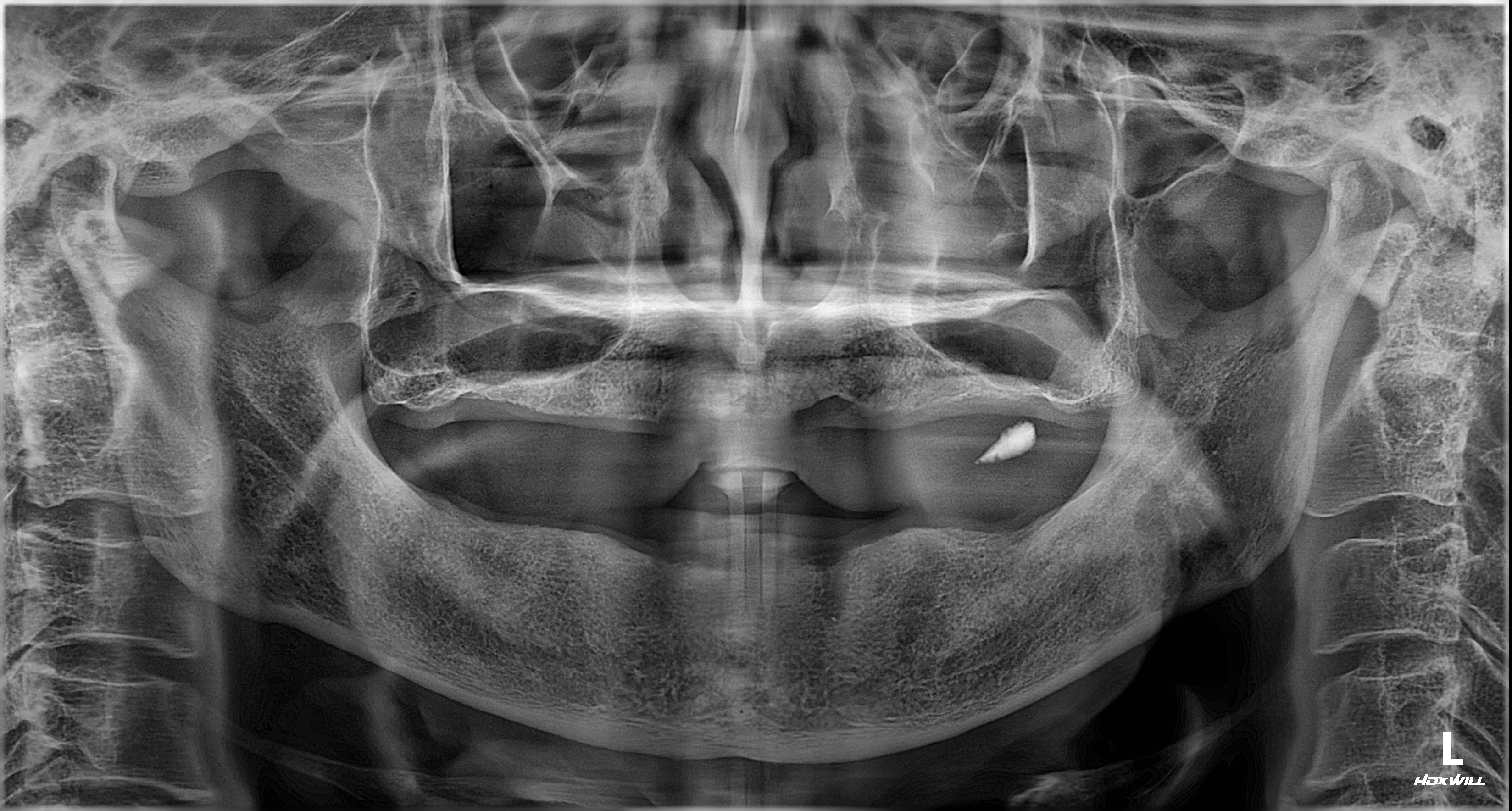 치료 전 파노라마 사진